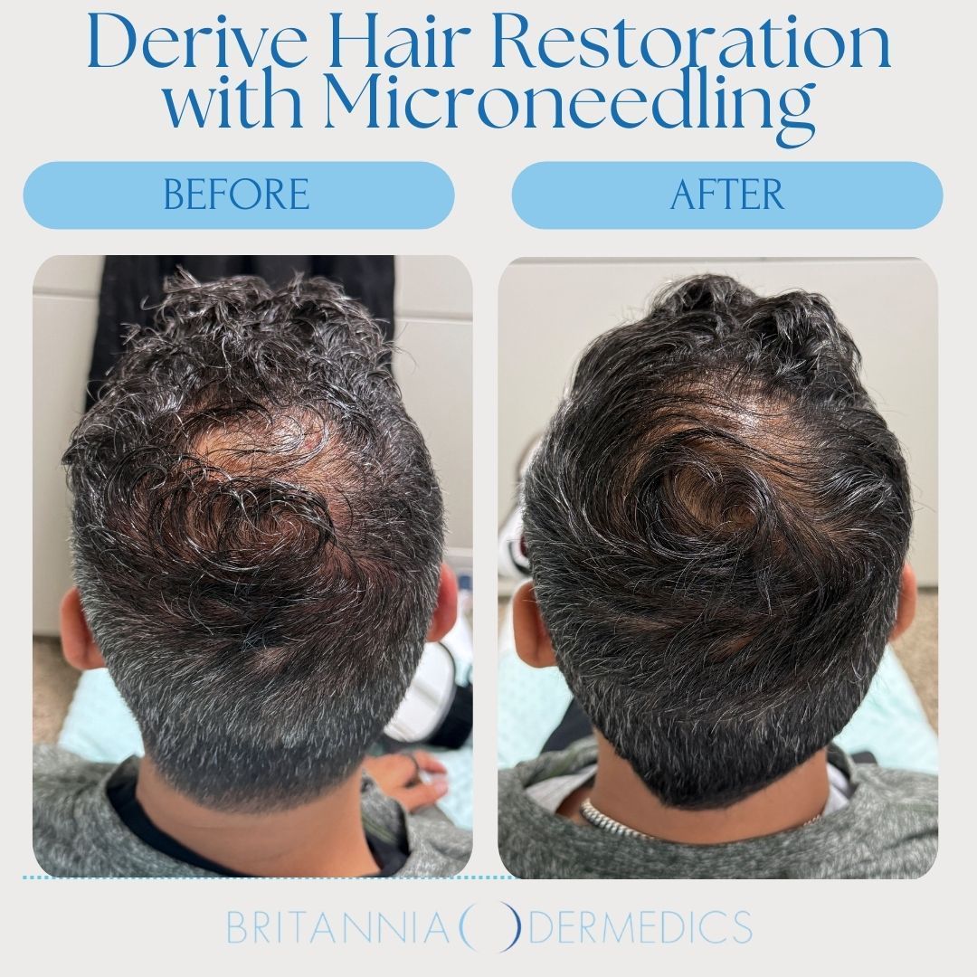Hair restoration results with microneedling. Before and after photos of a person's scalp, showing hair growth.
