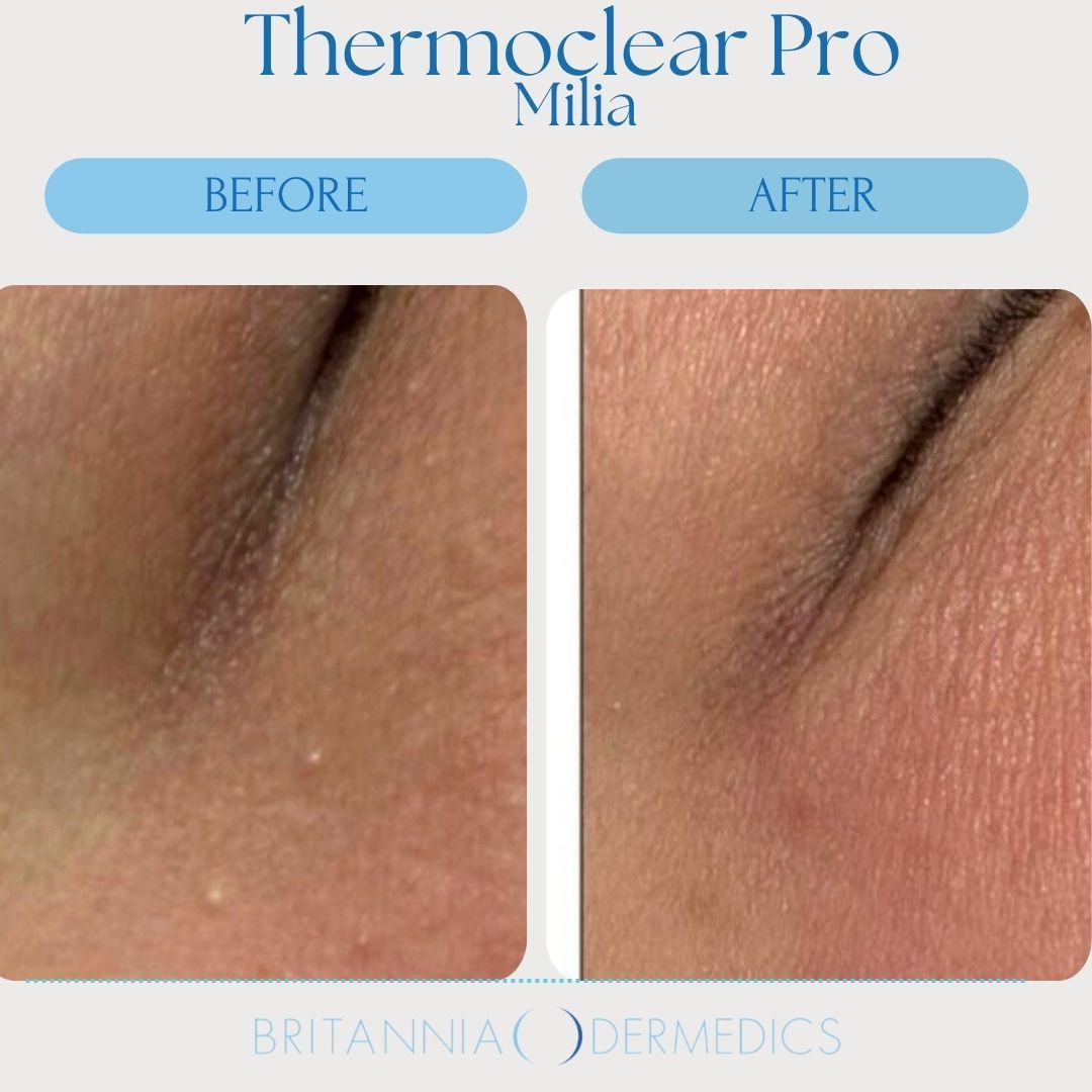 Before and after comparison of skin near an eye, demonstrating milia removal with Thermoclear Pro treatment.