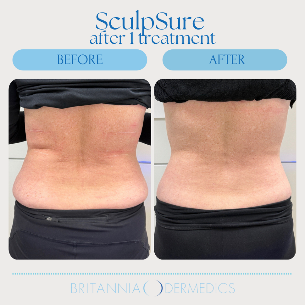 Before-and-after torso comparison of a back fat treatment, showing a smoother waist after treatment