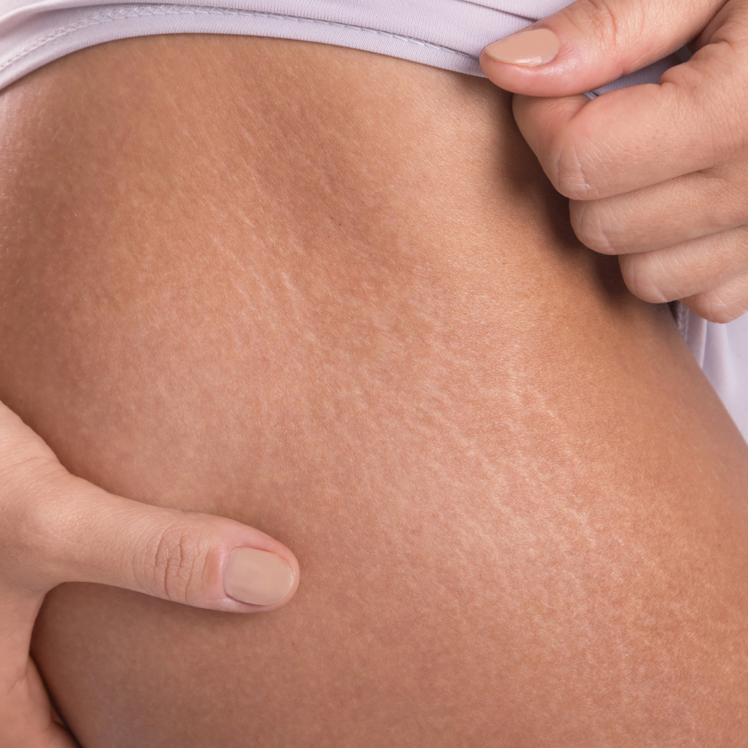 Close-up of human abdomen with numerous stretch marks, visible on light skin, wearing black underwear.