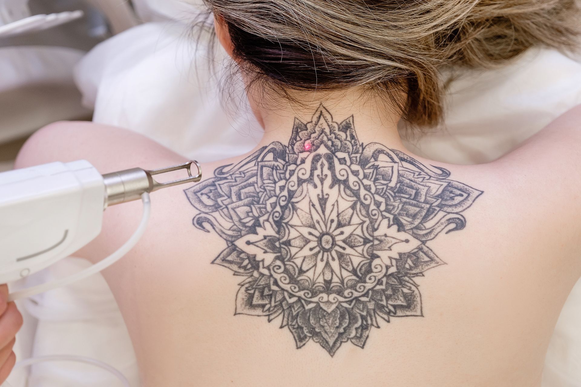 Back of a person undergoing tattoo removal with a laser device, focusing on a detailed back tattoo.