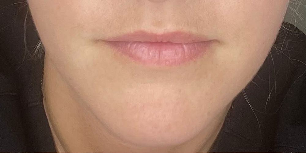 Dermal filler before and after result at A to Z Wellness Tampa