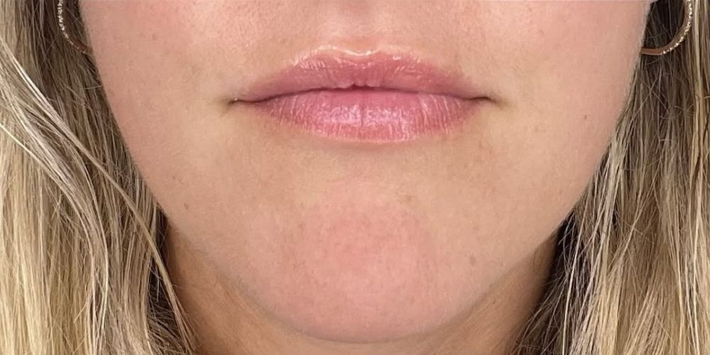 Lip filler before and after result at A to Z Wellness Tampa