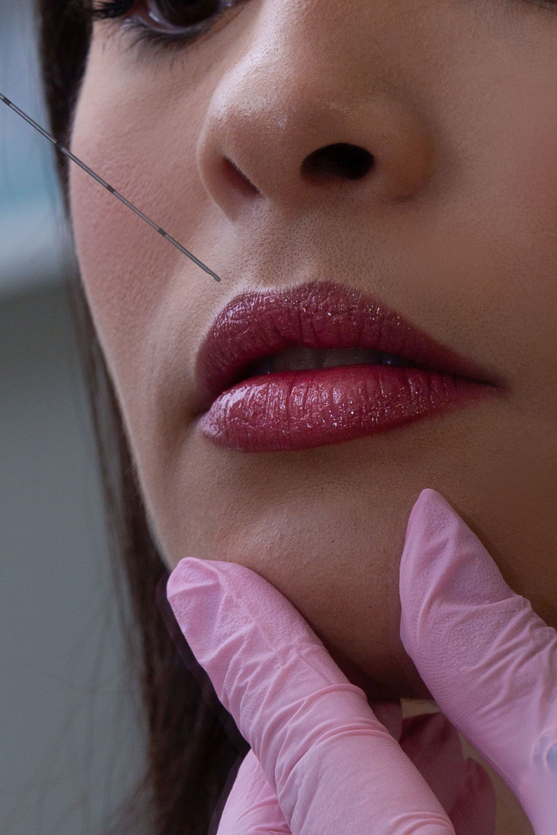 A dermal filler treatment being administered at A to Z Wellness in Tampa