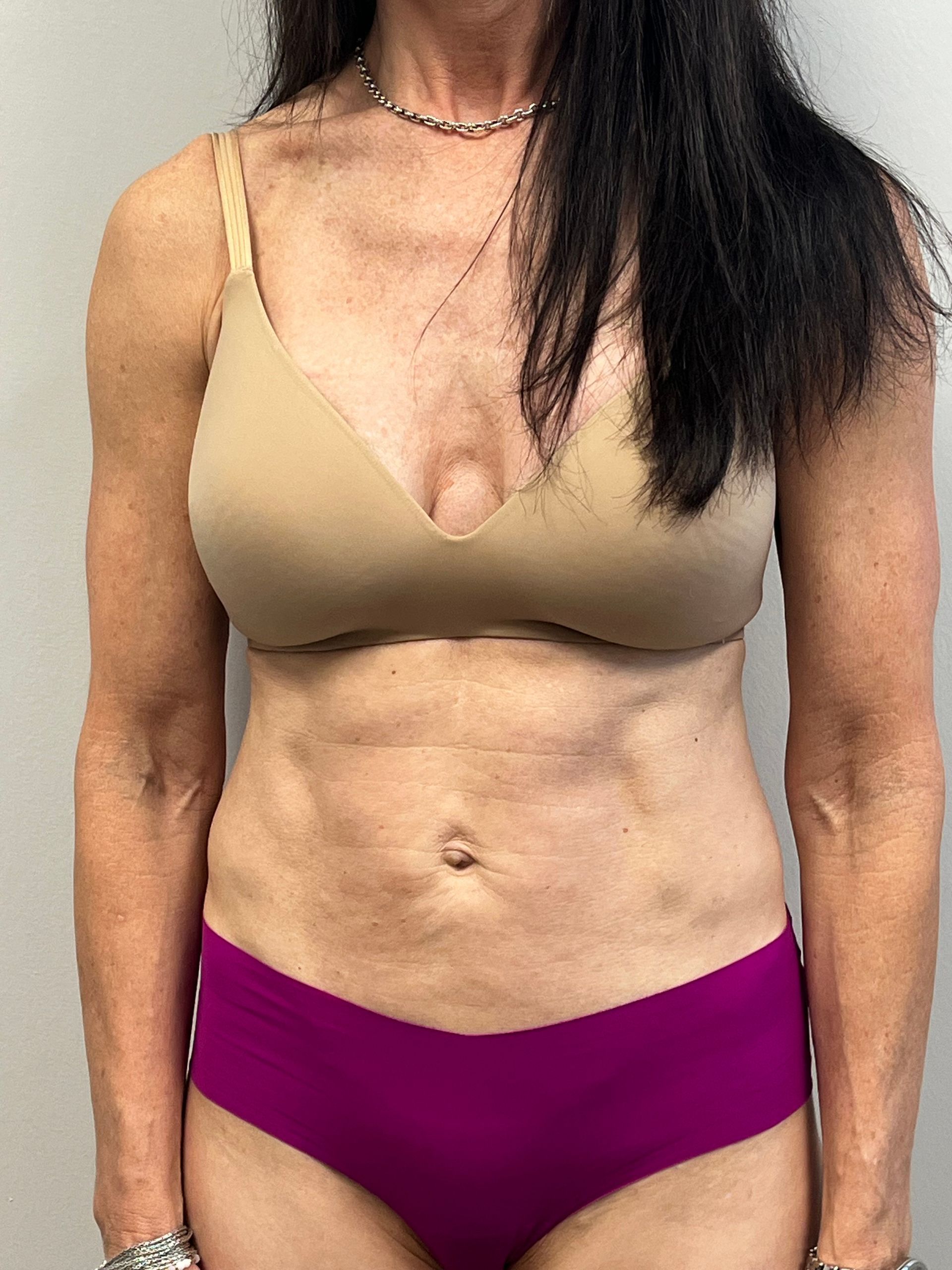 T-Shape 2 body sculpting before and after result at A to Z Wellness Tampa