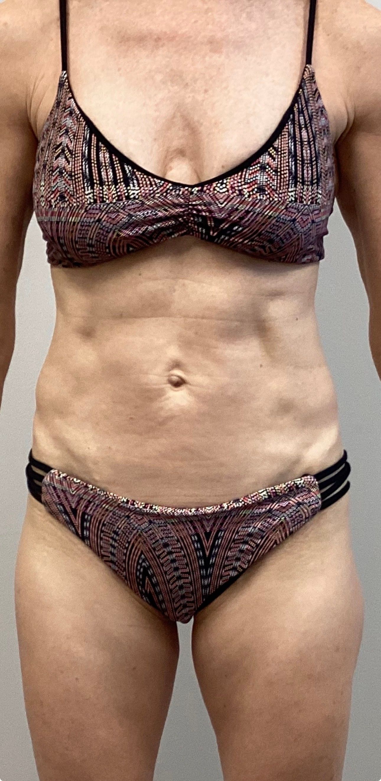 T-Shape 2 abdominal result at A to Z Wellness Tampa