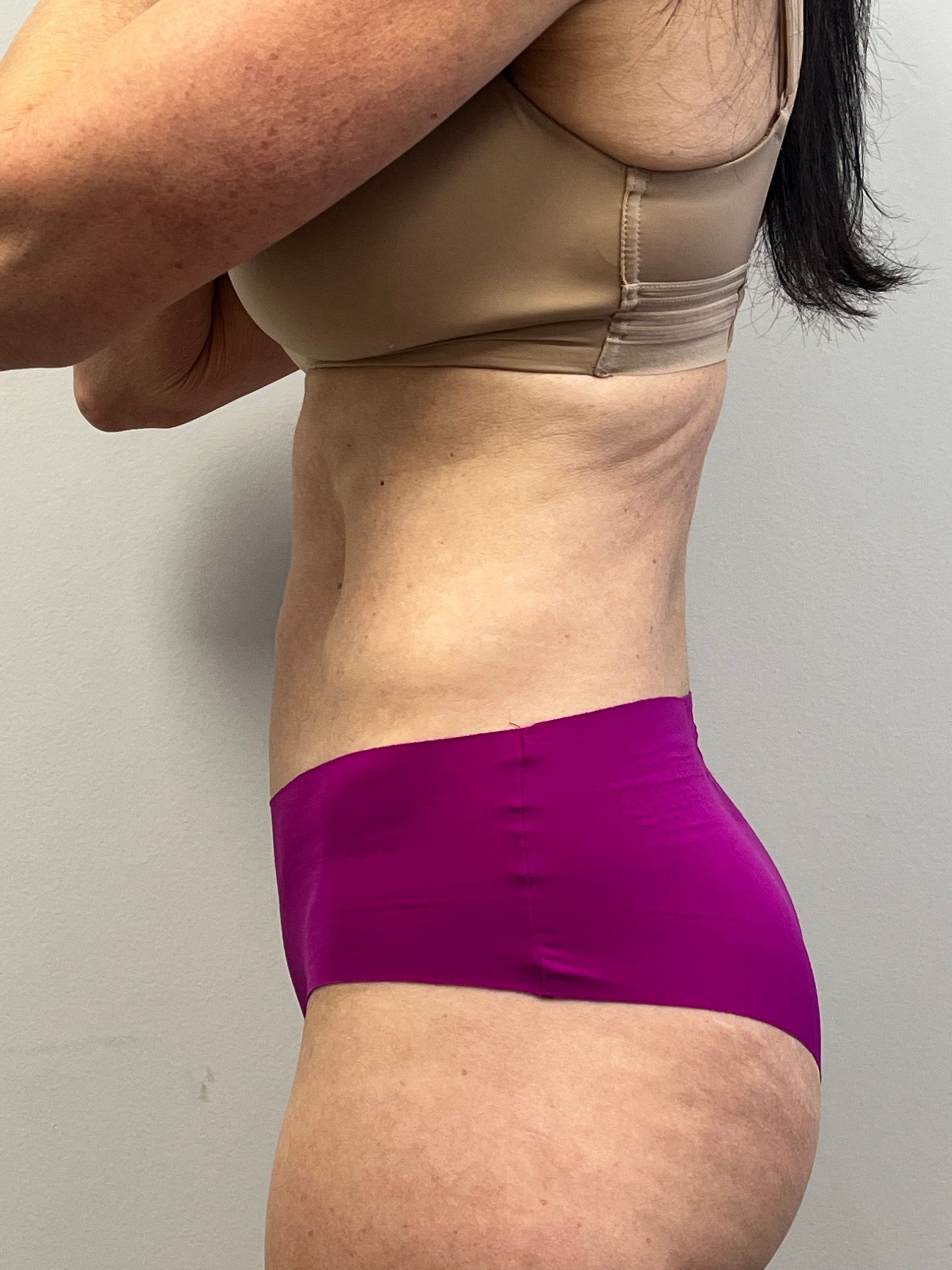 T-Shape 2 body contouring result at A to Z Wellness Tampa