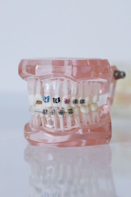 Modelo de ortodoncia rosa con brackets metálicos en dientes blancos, mostrado de perfil.