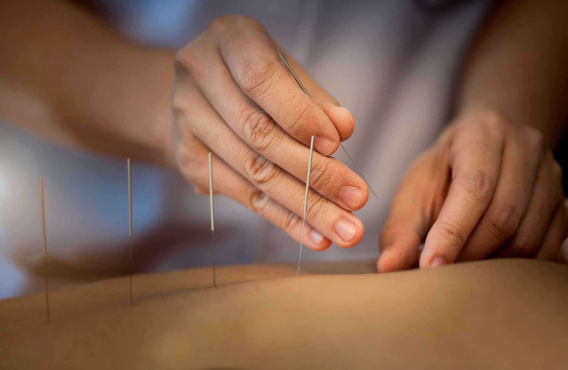 Hands placing thin acupuncture needles into a person's back during treatment