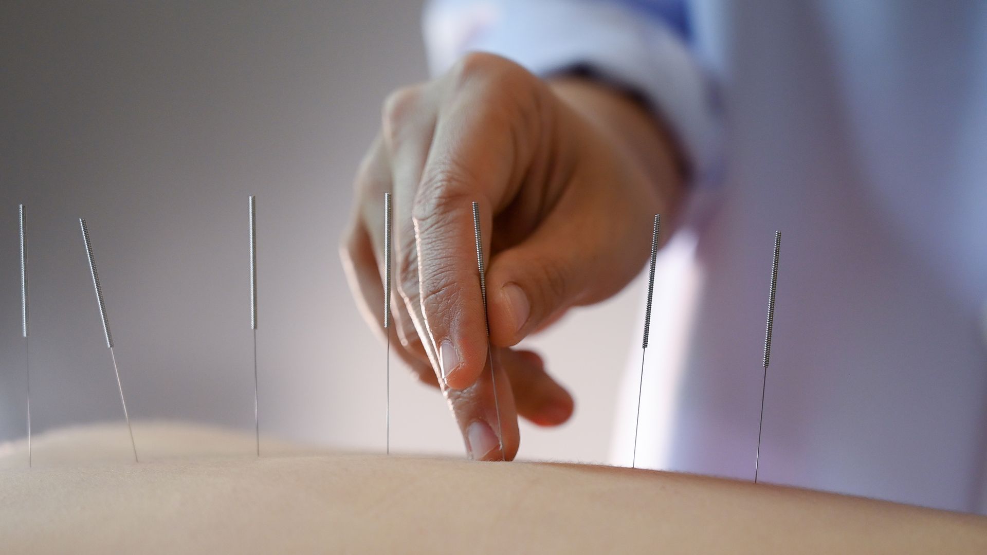 Hand placing fine needles into a patient’s back during acupuncture treatment