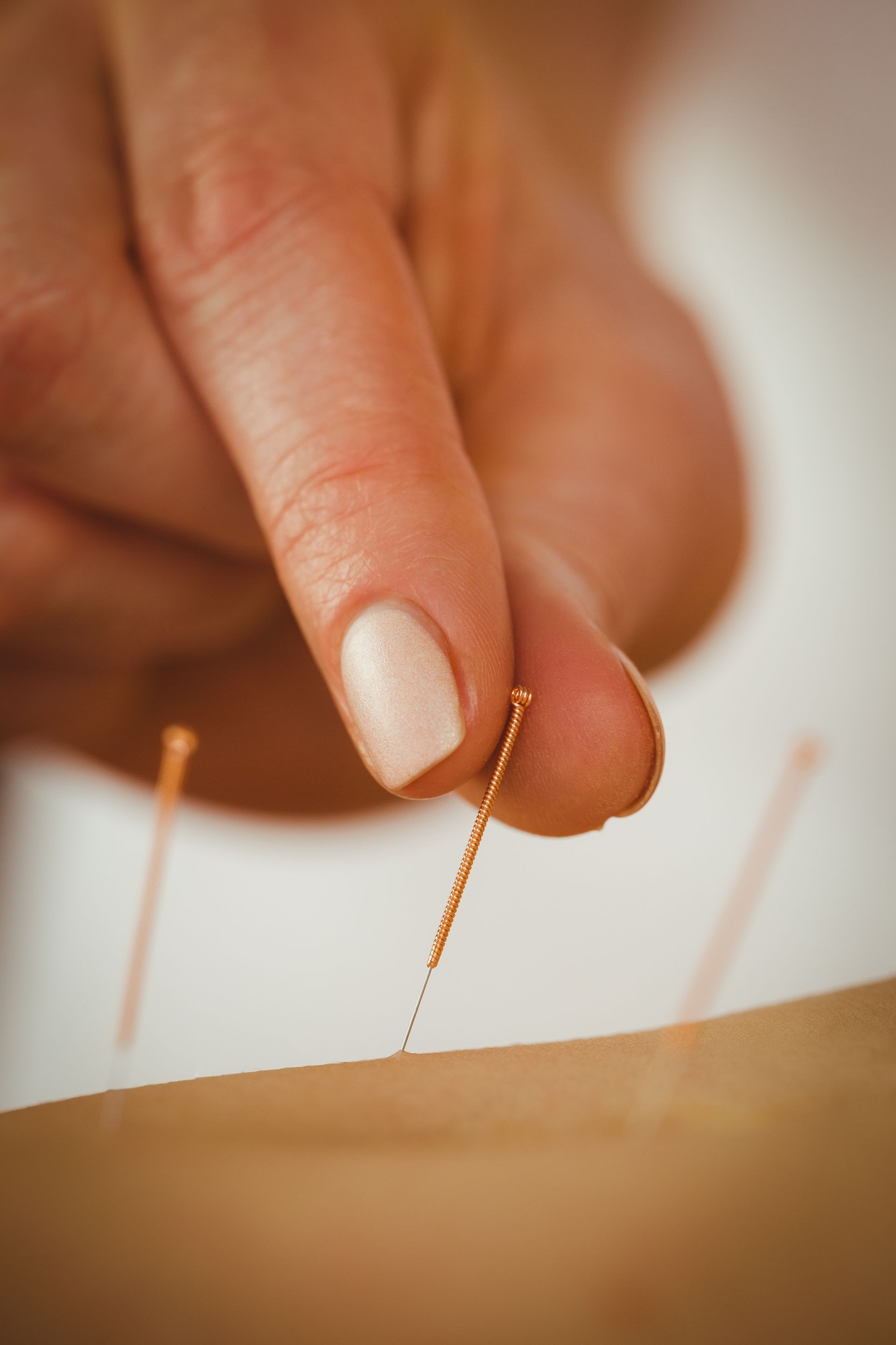 Close-up of a hand placing a thin gold acupuncture needle into skin