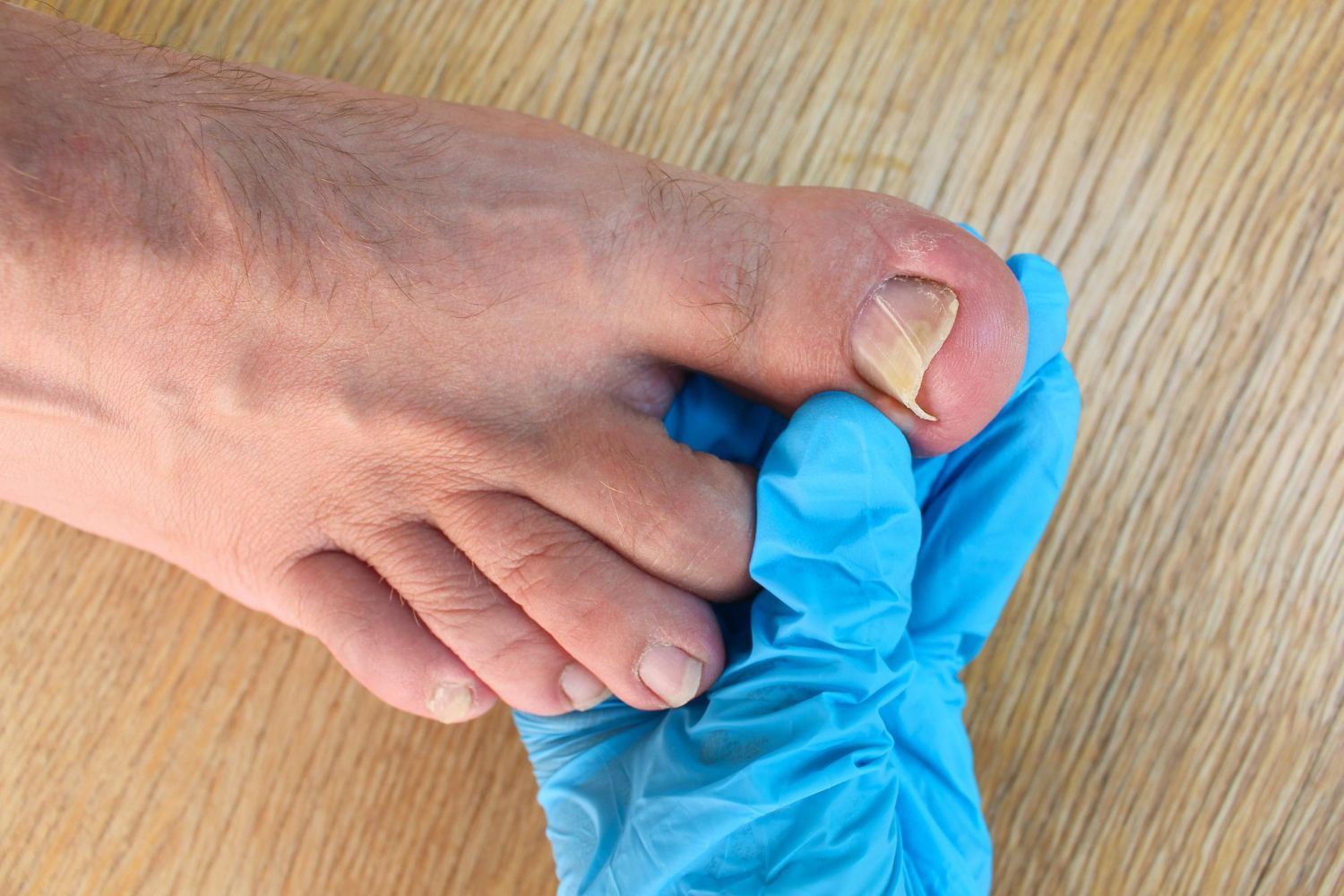 Close-up of a foot with a damaged toenail while a gloved hand examines the toe