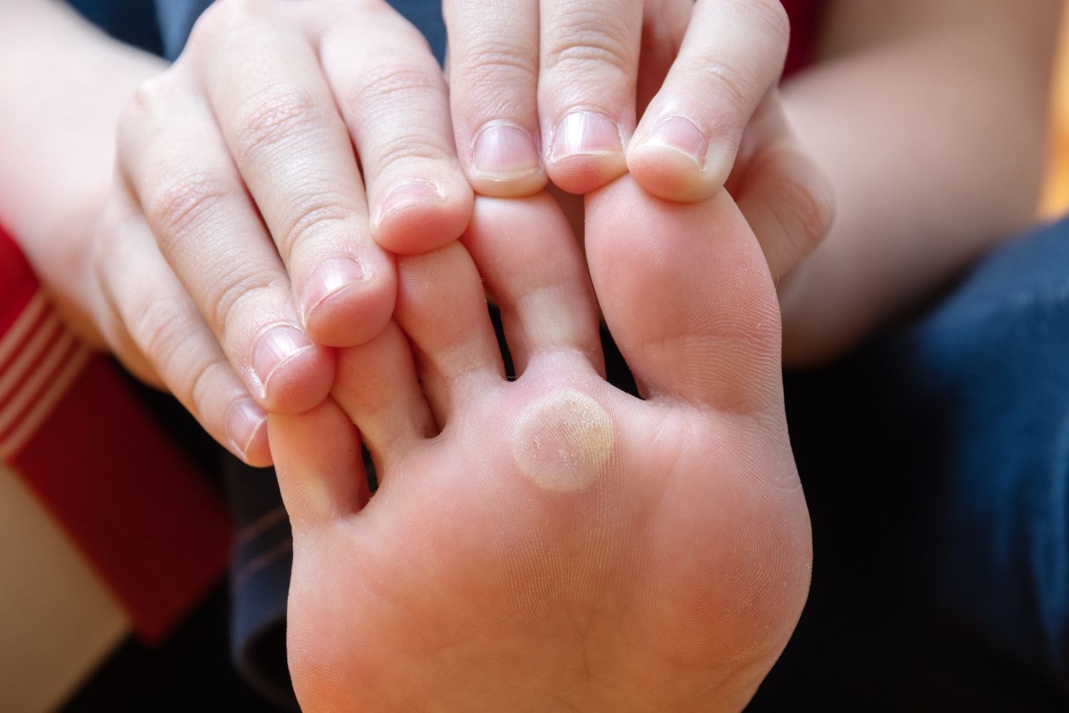 Hands holding a bare foot with a small round blister on the sole