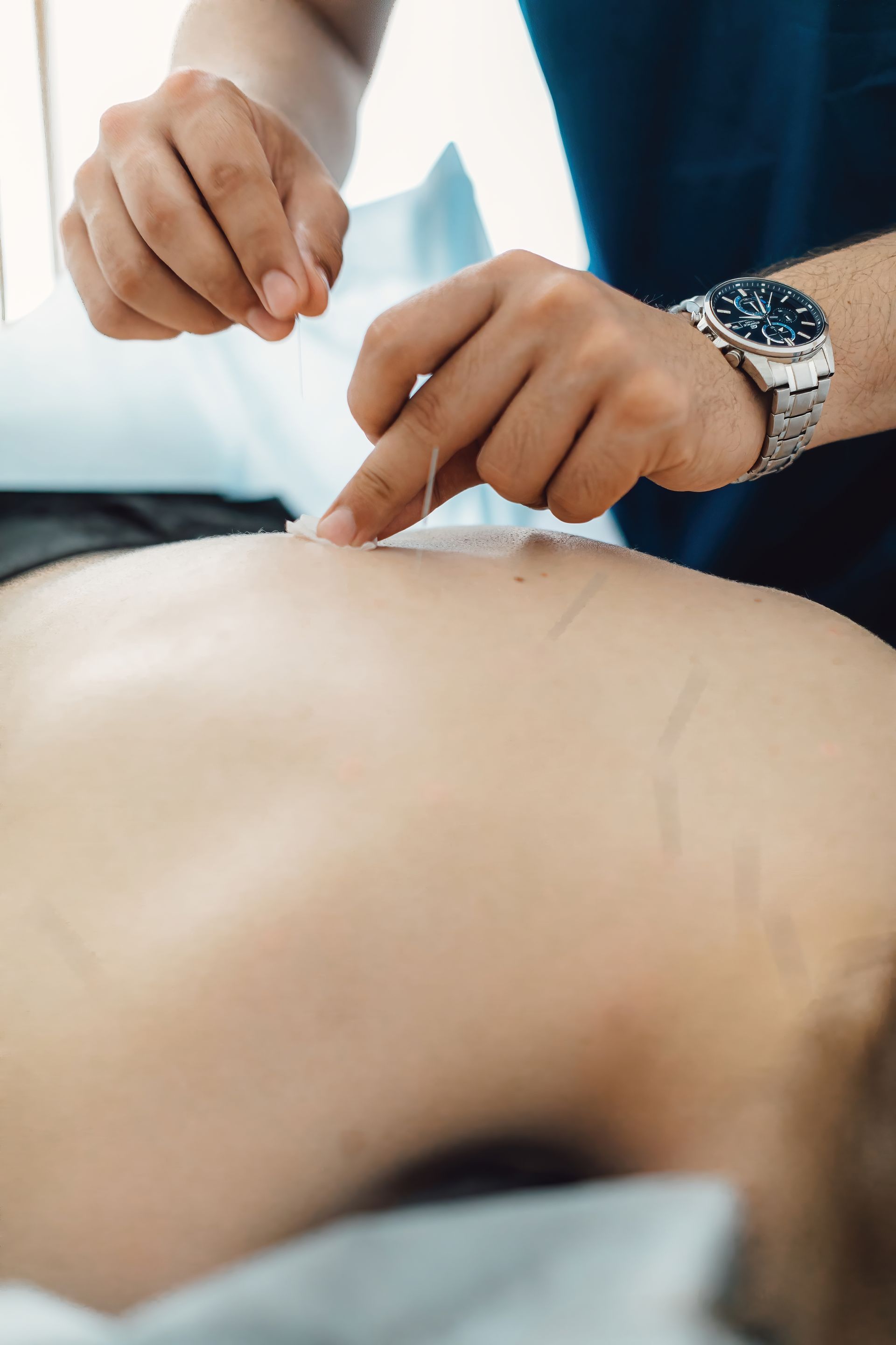A person is getting an acupuncture treatment on their back.
