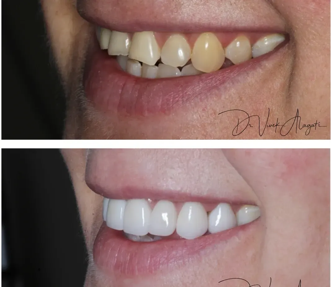 Before-and-after close-up of a smile, showing discolored teeth above and whiter teeth below.