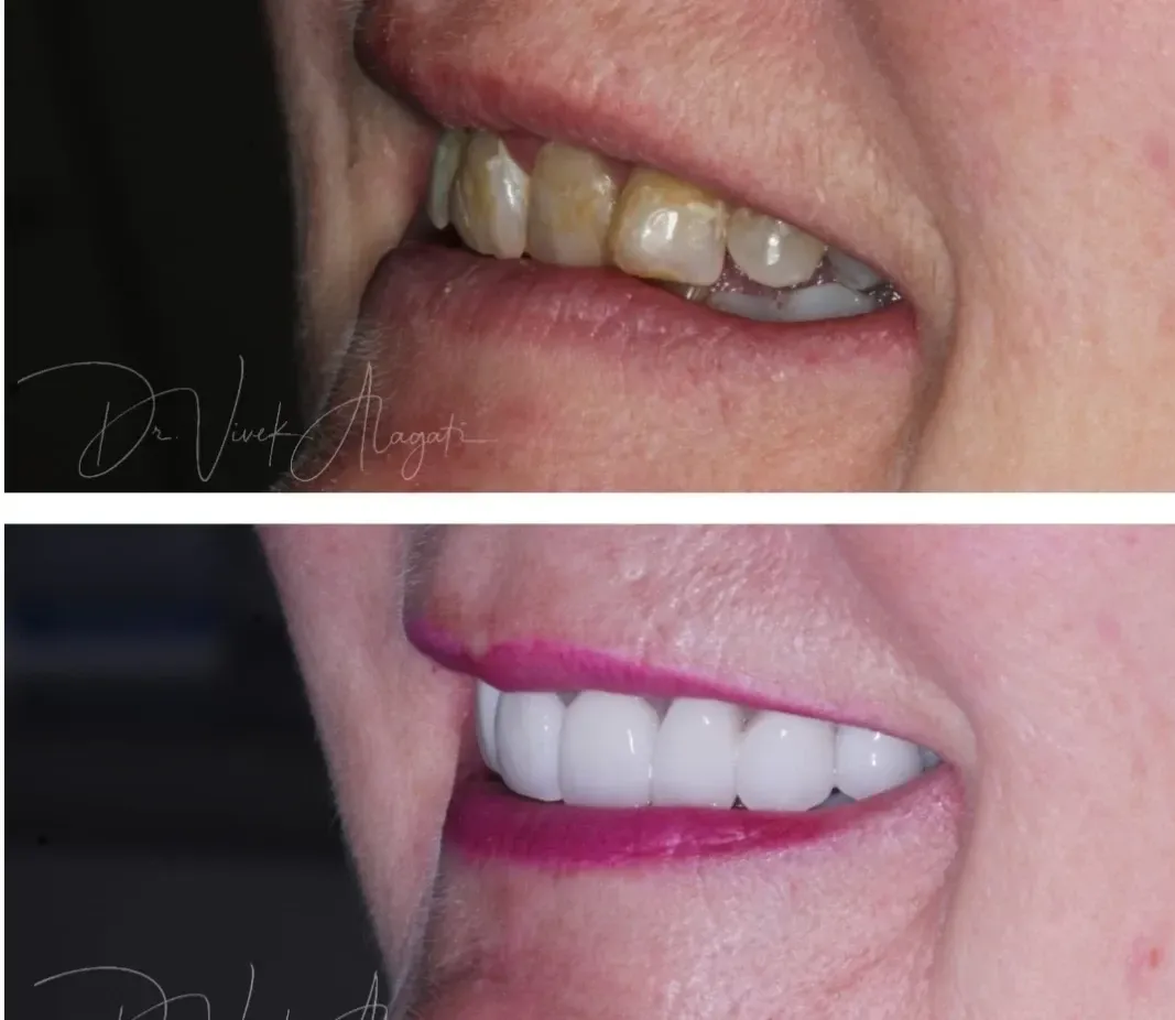 Side-by-side close-up of teeth before and after whitening, with pink lips and improved brightness.