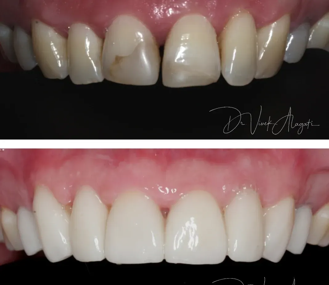 Before-and-after close-up of front teeth, showing discolored teeth transformed to bright white veneers.