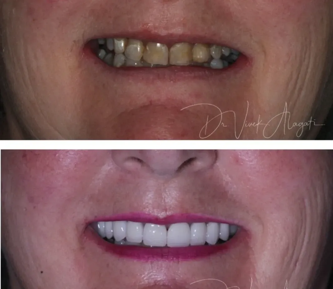 Before-and-after close-up of a smile showing discolored teeth above and bright white teeth below