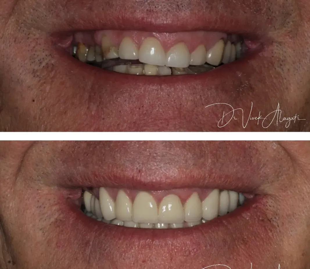 Close-up before-and-after smile showing improved, more even teeth alignment and color