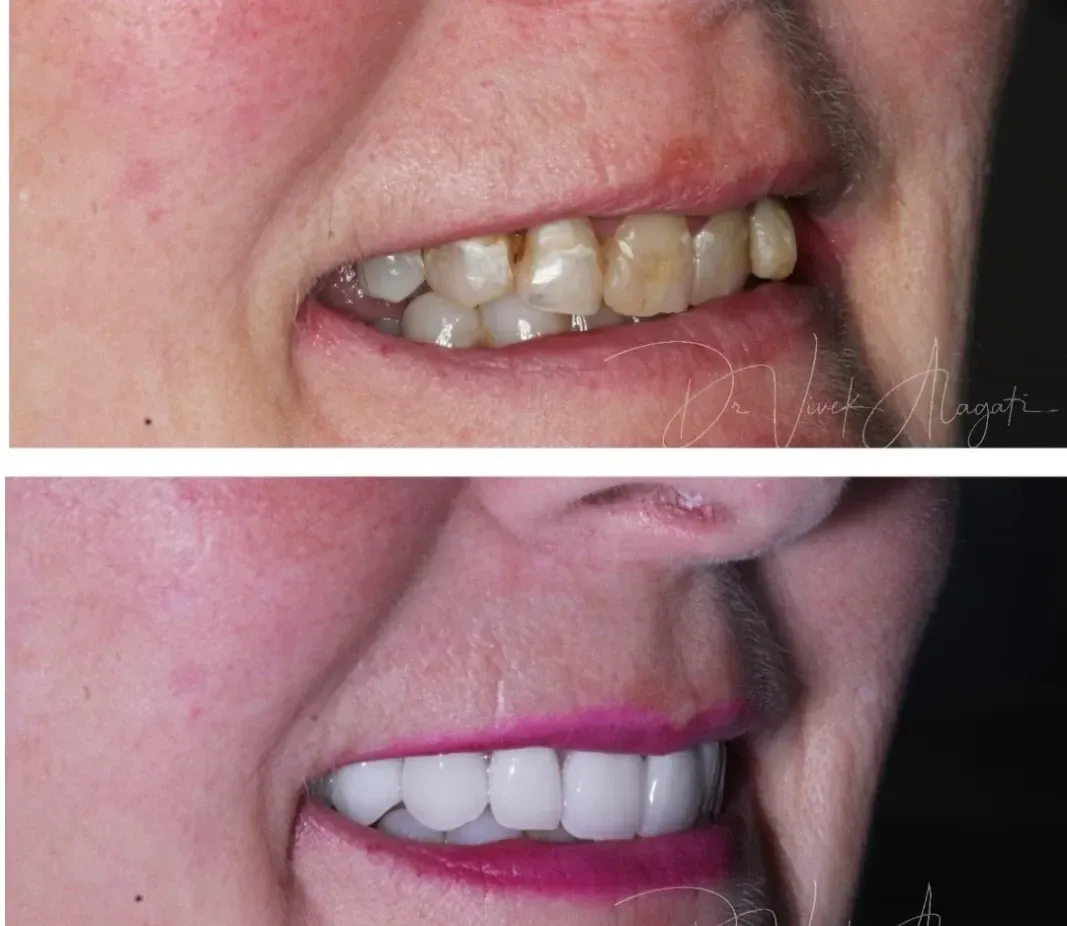 Before-and-after close-up of teeth whitening, showing discolored teeth above and brighter white teeth below