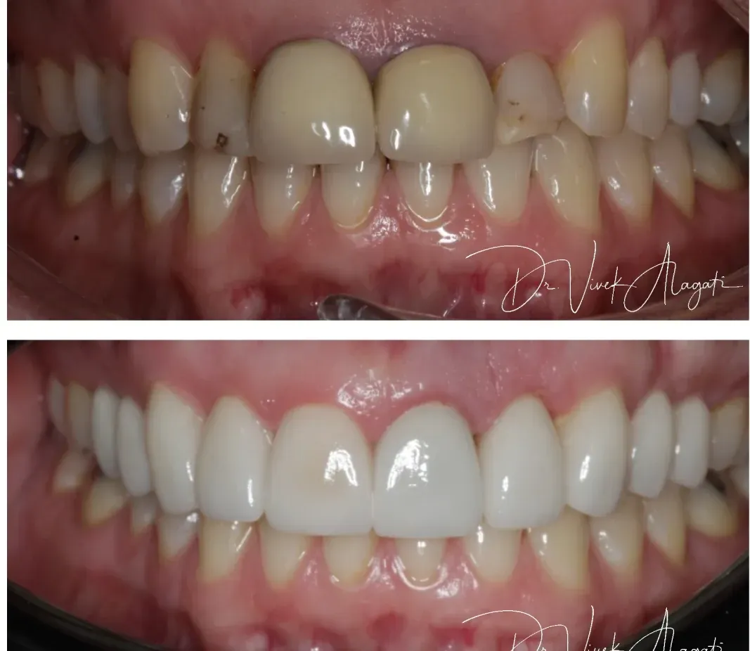 Close-up of teeth before and after whitening, showing brighter upper and lower teeth in the bottom image