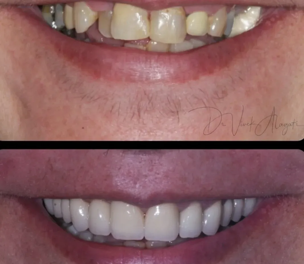 Before-and-after close-up of teeth whitening, showing yellowed teeth above and brighter white teeth below