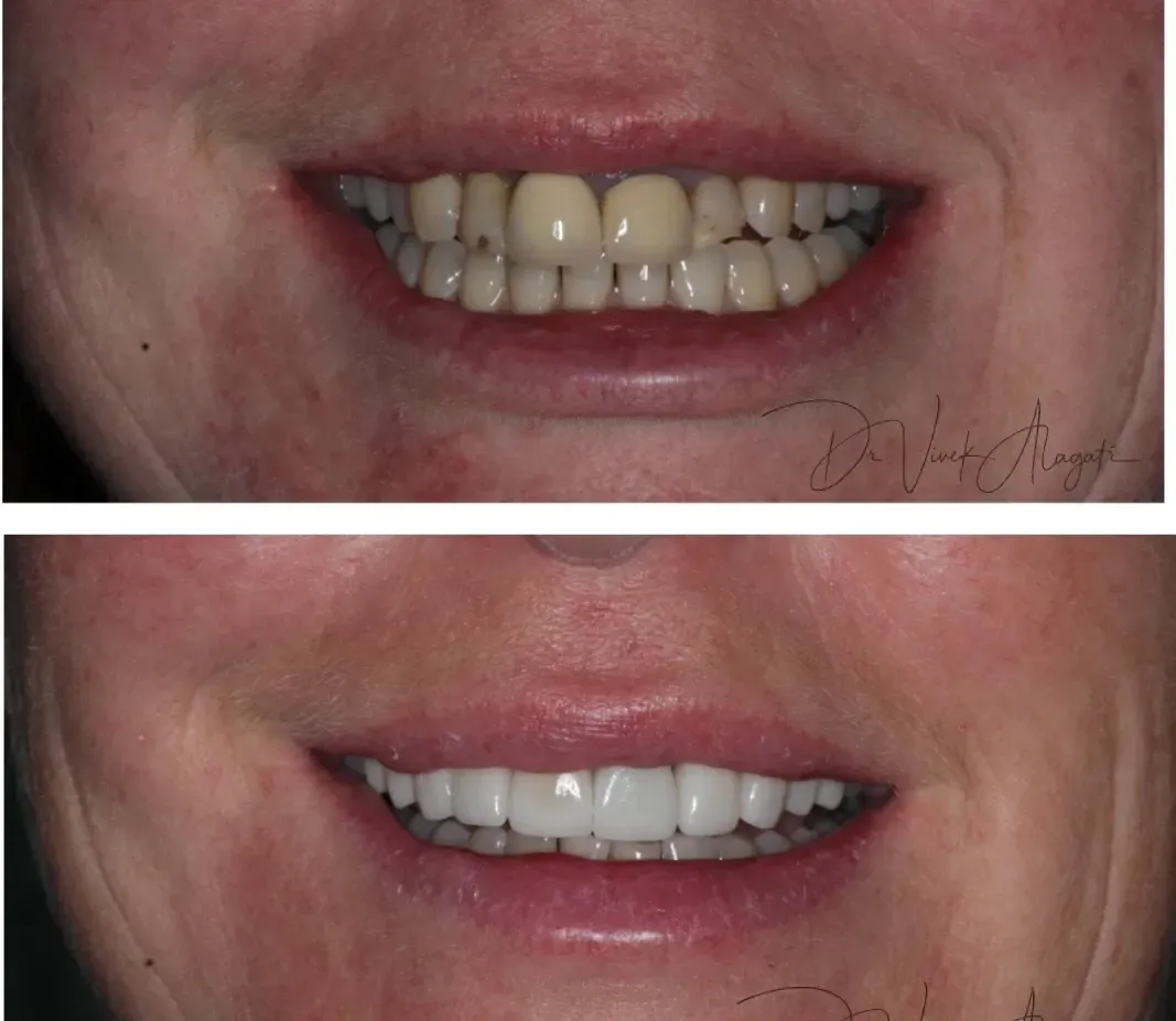Before-and-after close-up of a smiling mouth, showing whiter teeth in the lower image.
