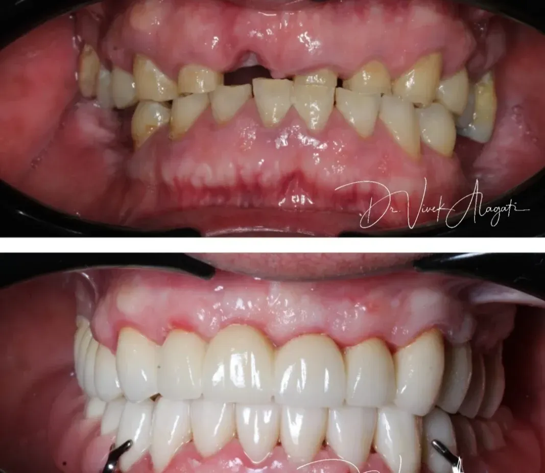 Before-and-after close-up of teeth: top shows crowded yellow teeth; bottom shows straight white teeth with braces.