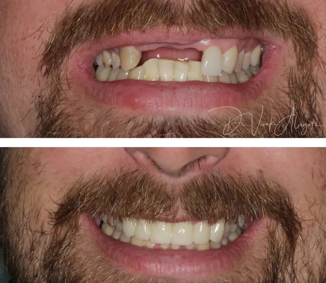 Close-up of a man's mouth with a dental gap, shown before and after tooth alignment.