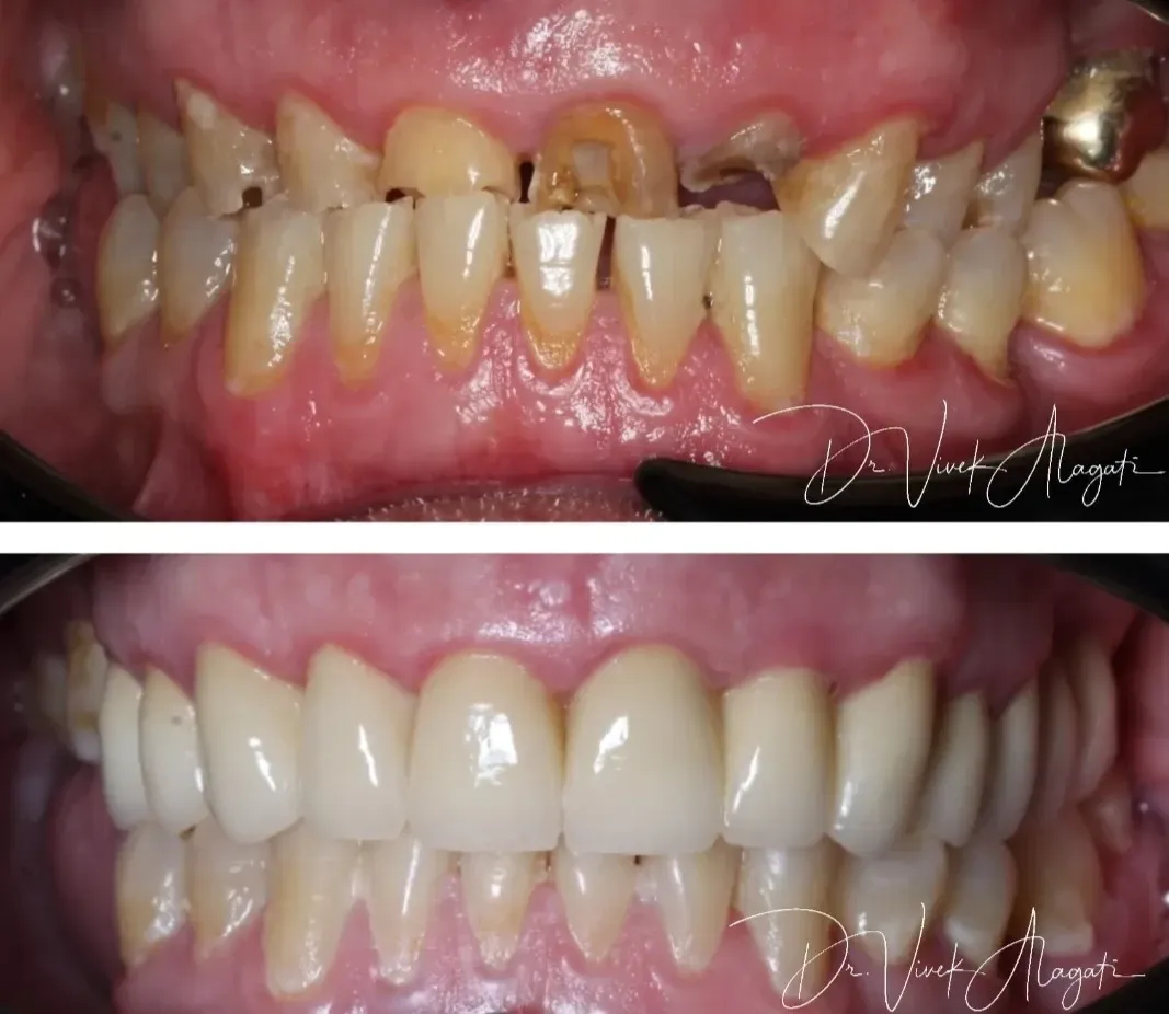 Dental before-and-after: severely discolored teeth above, restored white teeth below.
