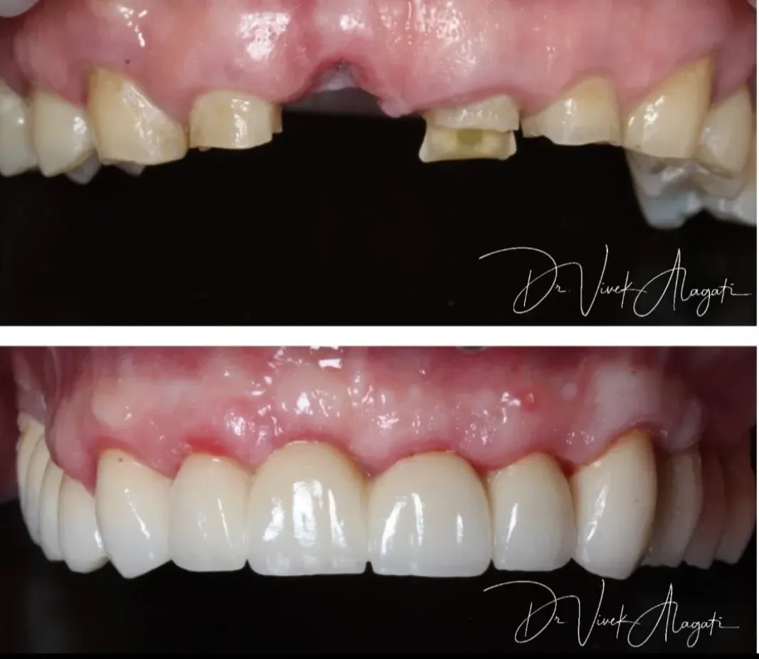 Before-and-after close-up of upper teeth, showing damaged teeth replaced with bright white veneers or crowns.