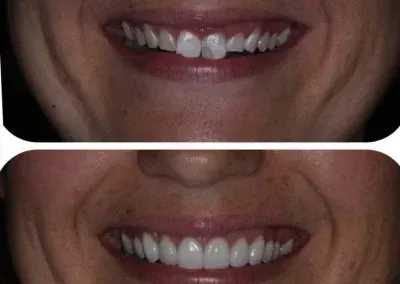 Close-up of a smiling mouth showing teeth before and after whitening treatment