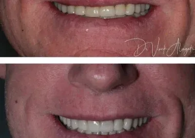 Close-up comparison of a smiling mouth before and after dental whitening treatment