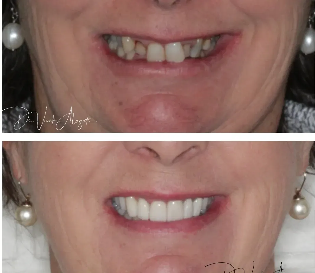 Before-and-after close-up of teeth, showing a missing and discolored smile above and a whiter repaired smile below