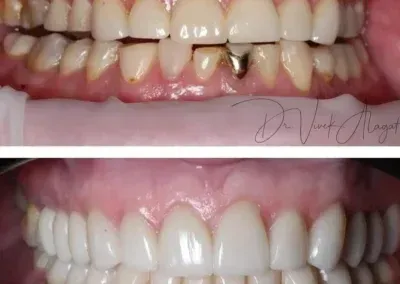 Before-and-after close-up of teeth and gums, showing a whiter smile in the bottom image