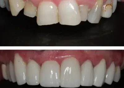Before-and-after close-up of front teeth, showing discoloration transformed to bright white veneers