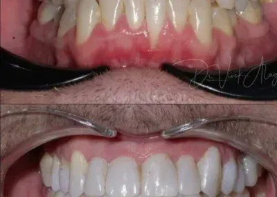 Close-up before-and-after of teeth and gums, showing a brightened smile and reduced gum redness