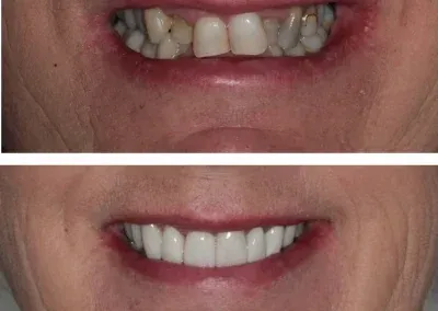Close-up of teeth before and after whitening, showing a brighter smile in the bottom image