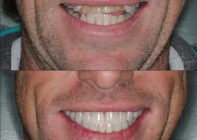 Close-up comparison of a mouth before and after teeth whitening, with a brighter smile below.