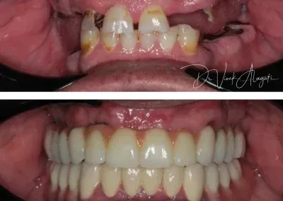 Before-and-after close-up of teeth: stained, crooked upper teeth changed to straight, bright white dentures or veneers.