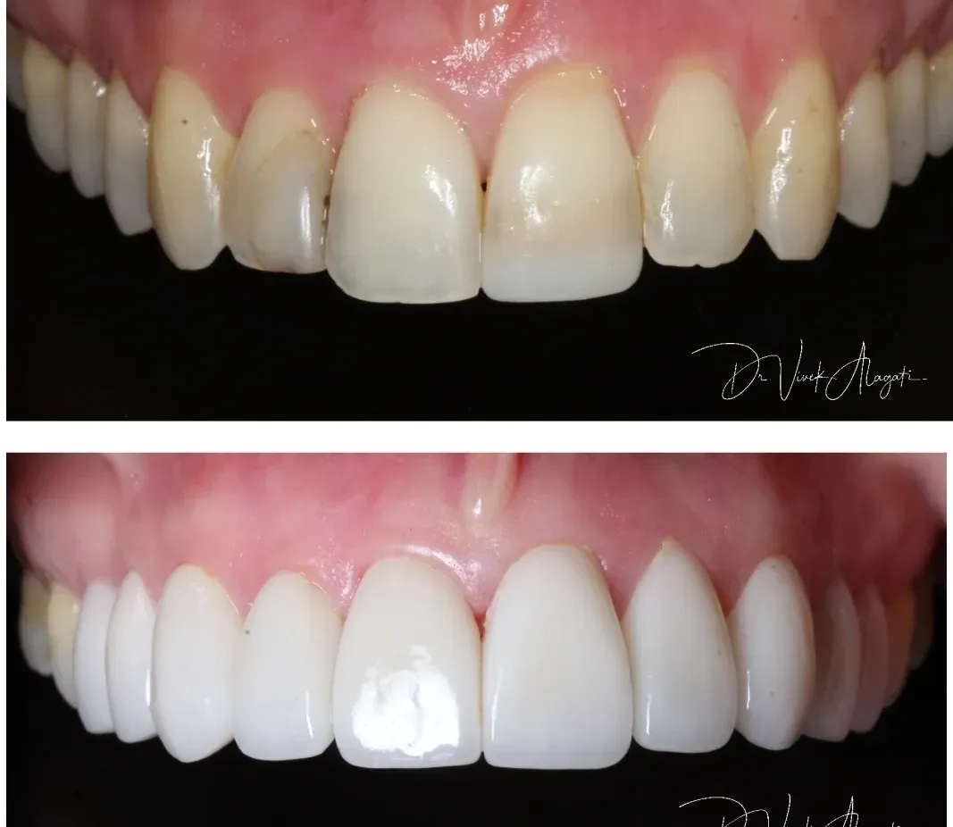 Before-and-after close-up of upper front teeth, showing stained teeth transformed to bright white veneers.