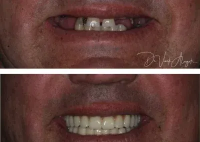 Close-up before-and-after smile showing missing teeth replaced with a full set of dentures.