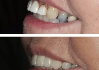Before-and-after close-up of teeth whitening, showing stained teeth above and whiter teeth below.