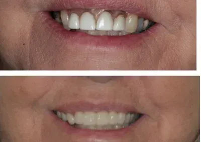 Close-up of a smiling mouth showing before-and-after teeth whitening results.