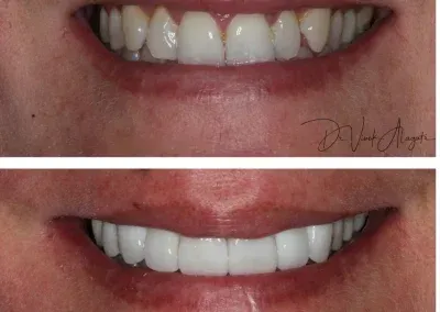 Before-and-after close-up of a smile, showing whiter teeth in the bottom image.