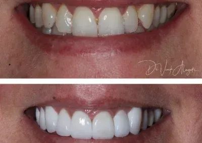 Before-and-after close-up of teeth whitening, showing brighter white teeth on the bottom.