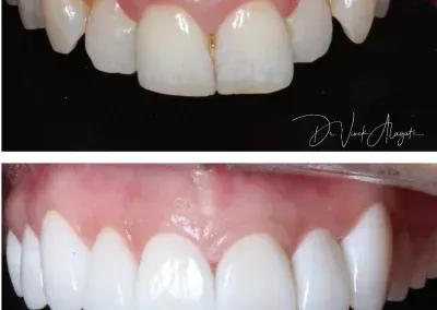 Before-and-after close-up of front teeth and gums, showing improved alignment and color