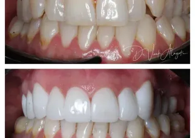 Before-and-after close-up of teeth whitening, showing yellow teeth above and brighter white teeth below.