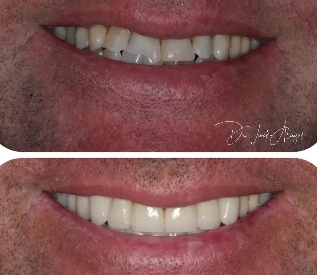 Before-and-after close-up of a smile, showing improved teeth alignment and brighter whitening.