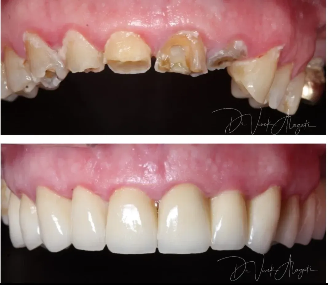 Before-and-after dental restoration: damaged upper front teeth replaced with bright white veneers.